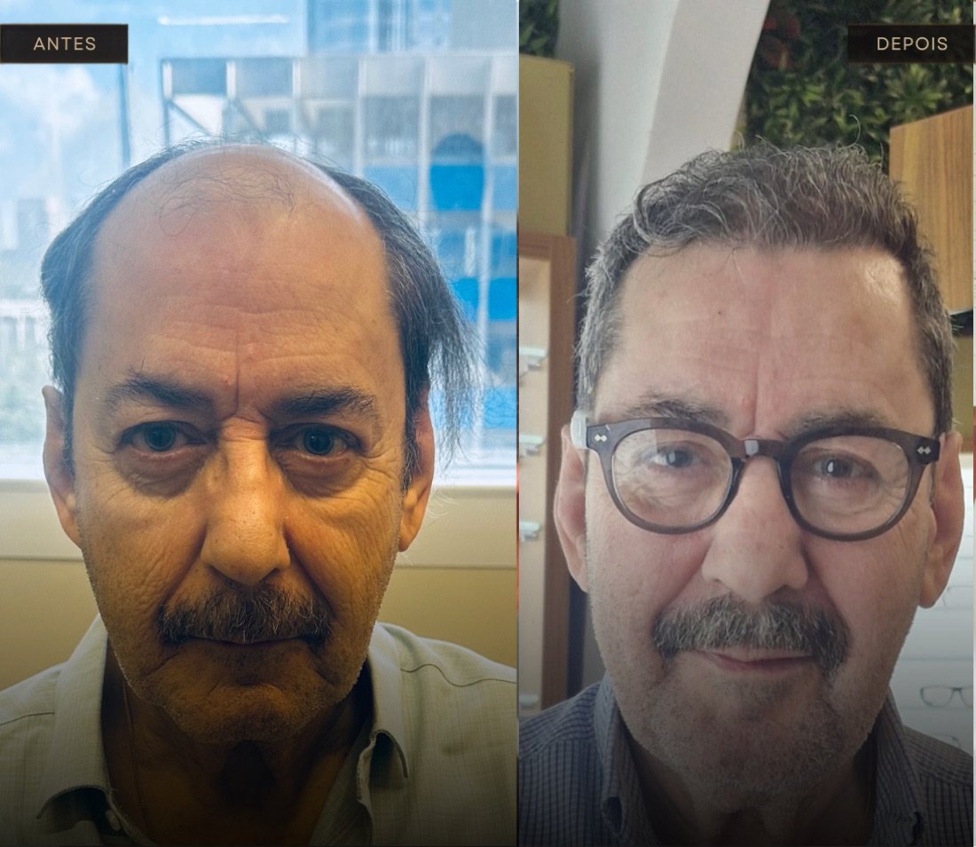Paciente que veio da Espanha para transplante capilar no Instituto Renovare