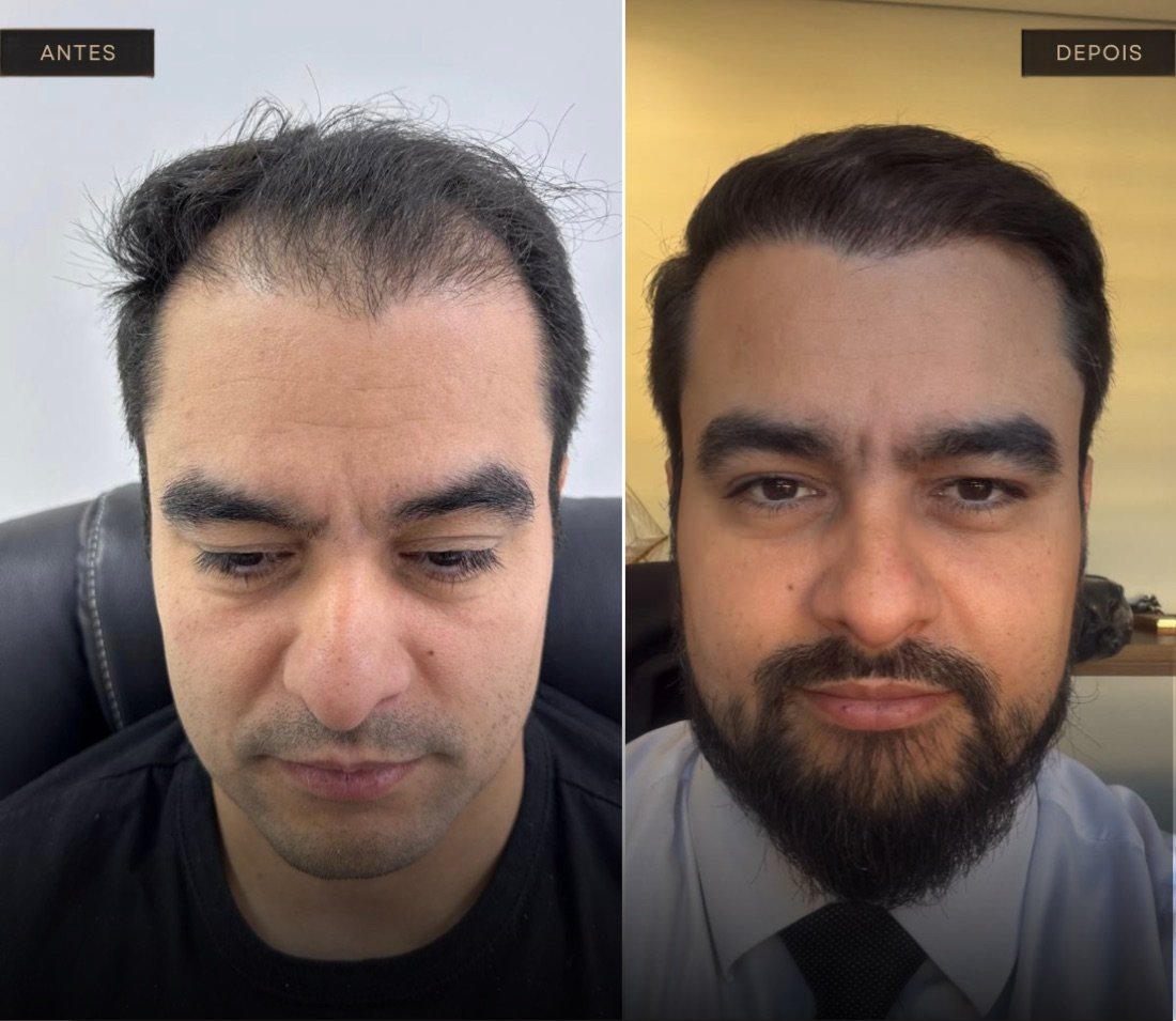 Resultado de transplante capilar com 6 meses de pós-operatório